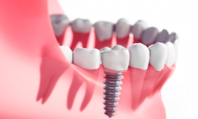 Dental Implant Newcastle