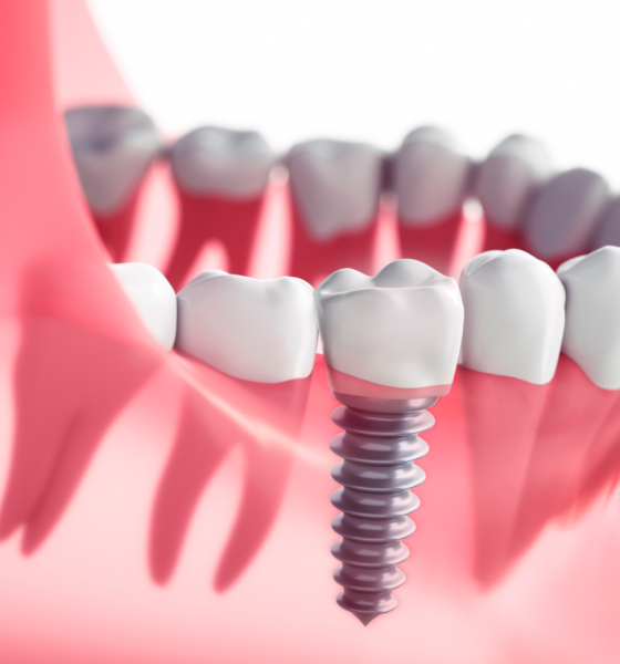 Dental Implant Newcastle