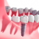 Dental Implant Newcastle
