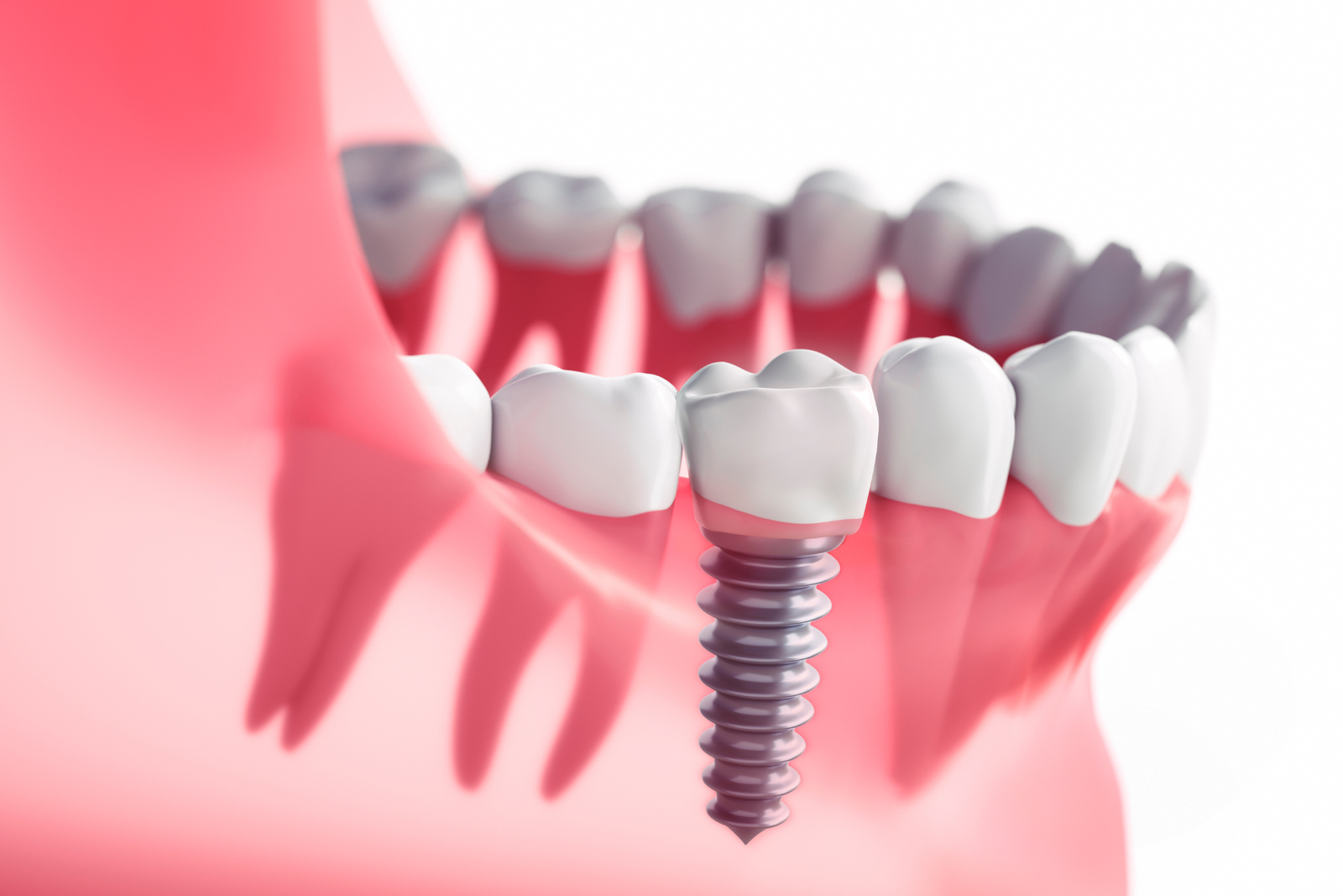 Dental Implant Newcastle
