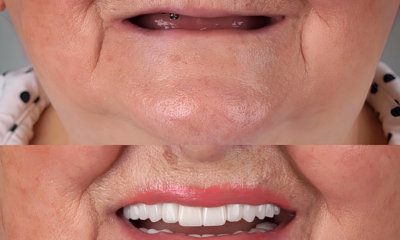 Dental Implants Newcastle 