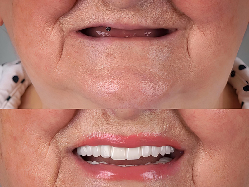 Dental Implants Newcastle 