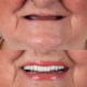 Dental Implants Newcastle 