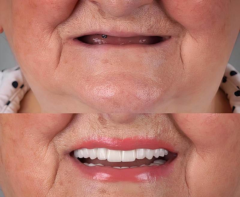 Dental Implants Newcastle 